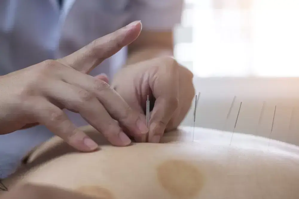 Acupuncture Pregnancy Induction Methods