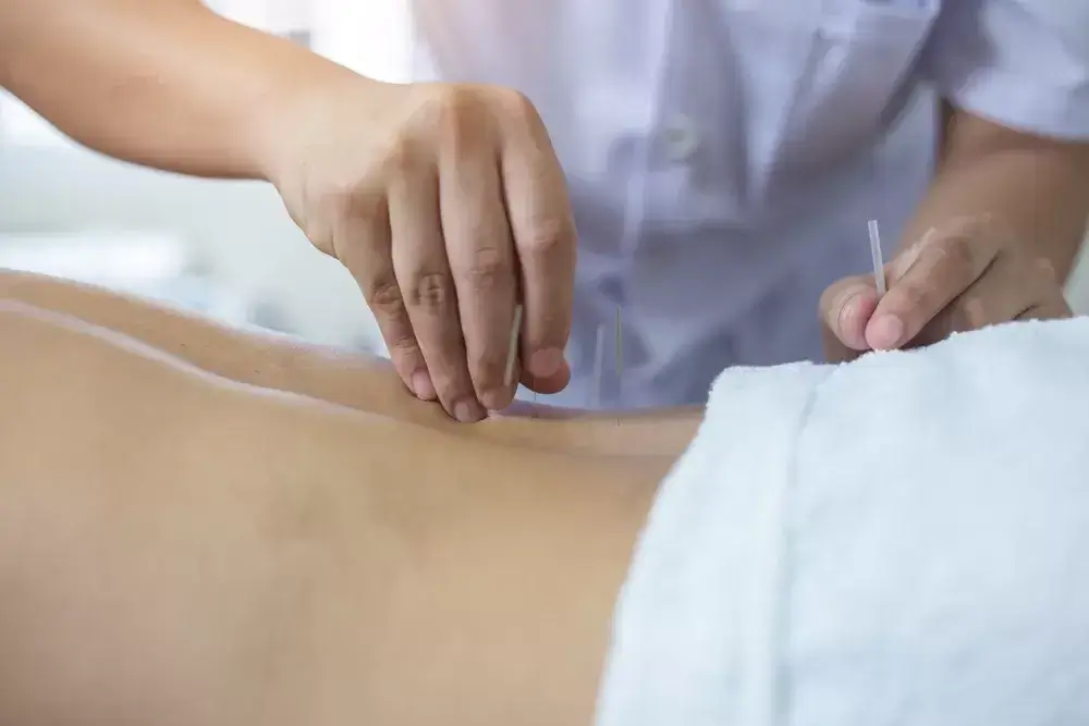 Best-Acupuncture-Treatment-near-Oakville