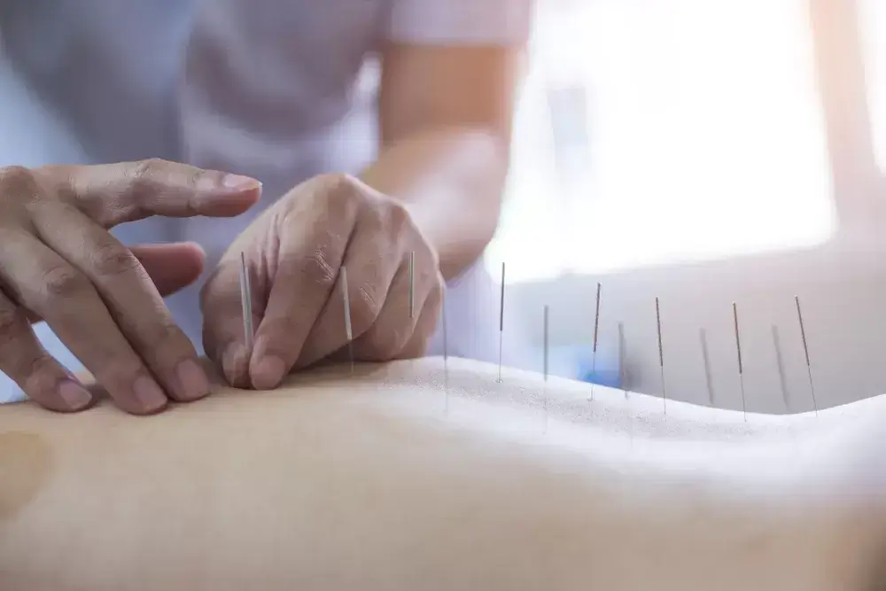 Oakville Acupuncture Treatment