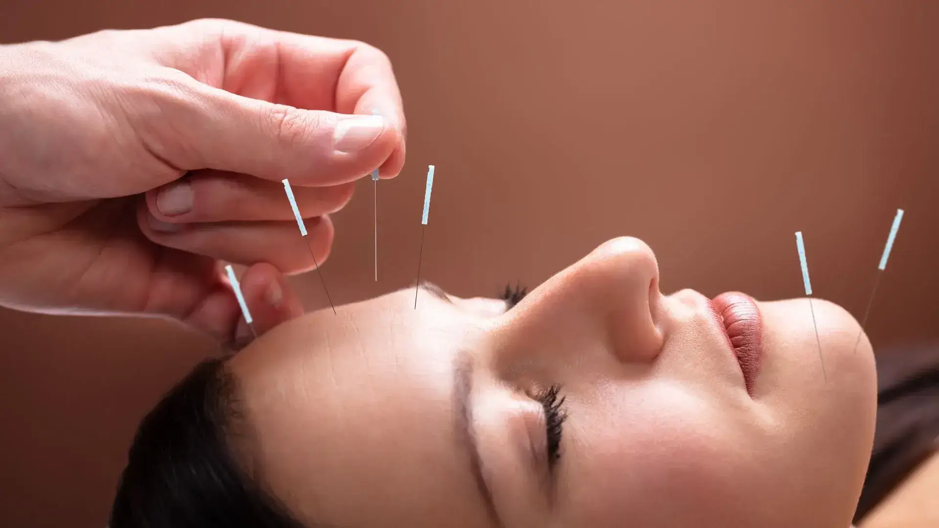"Oakville Acupuncture" - Acupuncture Treatment for Muscles, Bones, Joints Pain, Nervous System, Pregnancy Acupuncture and Induction with Acupoints and acupuncture-needles. 4 Why Choose Us