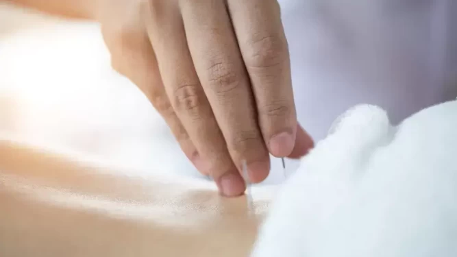 Infertility Acupuncture