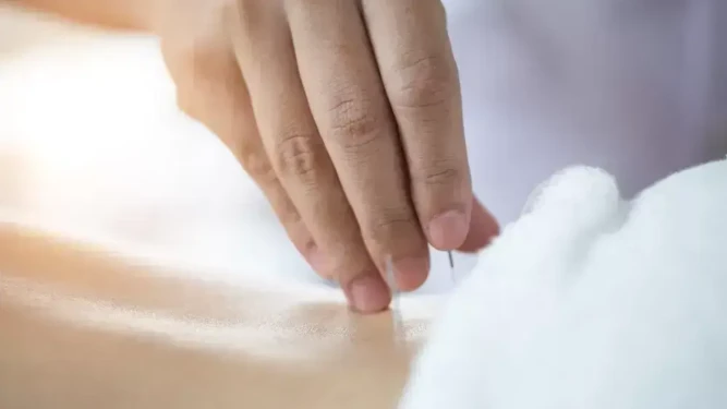 Infertility Acupuncture