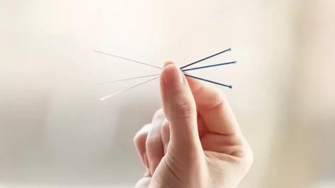 What is Acupuncture Treatment